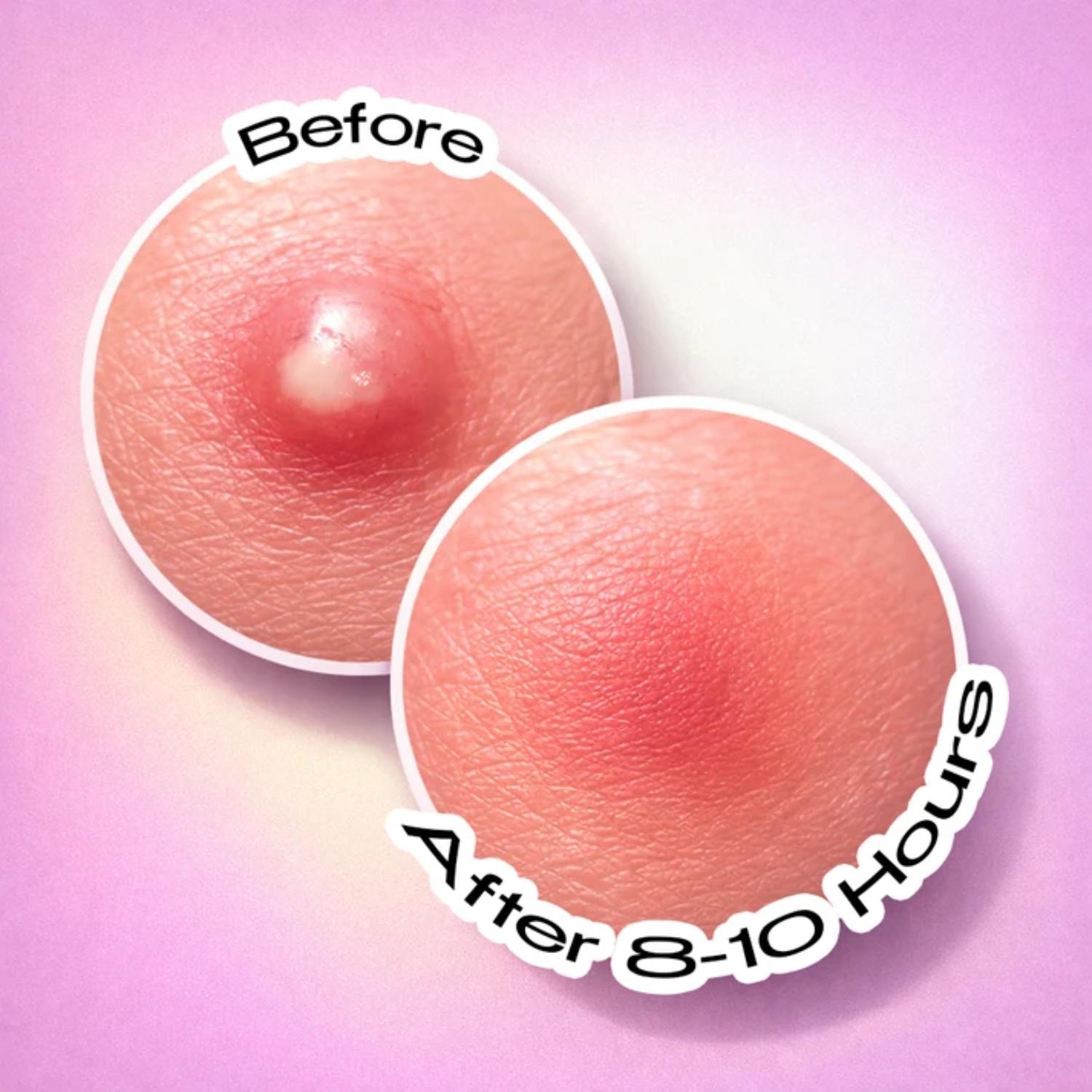 RECODE ACNE PATCH PACK OF 36