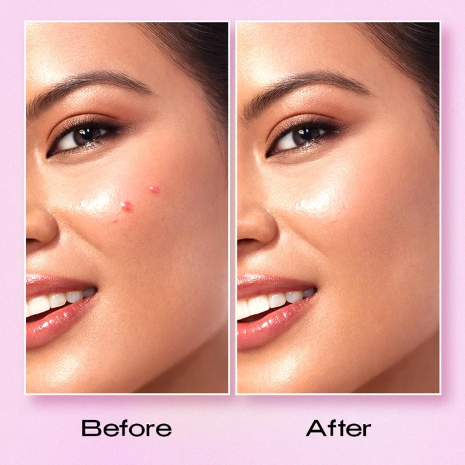 RECODE ACNE PATCH PACK OF 36